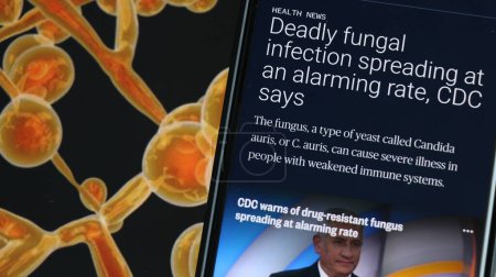 Foto de Informe de los CDC - Infección fúngica mortal (candida aurius) que se propaga a un ritmo alarmante. - Imagen libre de derechos