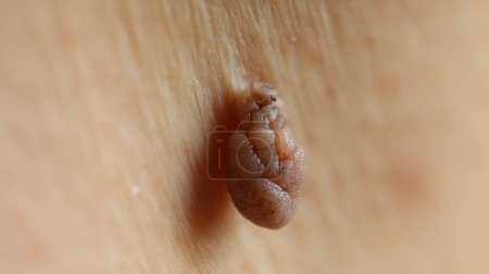 Close up - A skin tag or a polypoid outgrowth that is attached to the skin and hangs from a small stalk or peduncle.