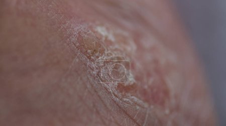 Photo for Keloid - A raised scar after an injury or cut surgery has healed. It is caused by an excess of a protein (collagen) in the skin during healing. - Royalty Free Image
