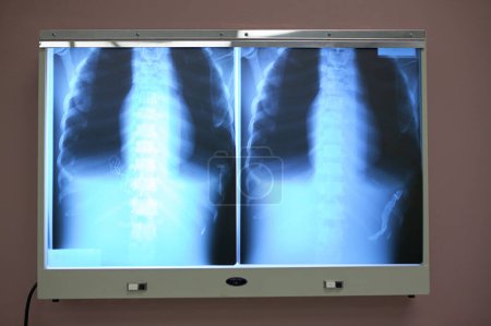 Photo for Chest, ribcage and thorax x-ray on a viewing light box in a hospital for the detection of bone fractures or disease in a patient - Royalty Free Image