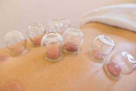 Photo for Traditional Chinese Cupping Therapy on the Back by Naturopath. Chinese Cup. Naturotherapy, massages, alternative medicine, natural medicine. - Royalty Free Image