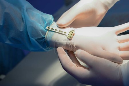 Foto de Los médicos eligen tornillos y tornillos ortopédicos para la cirugía. Close-up.Foto de alta calidad - Imagen libre de derechos