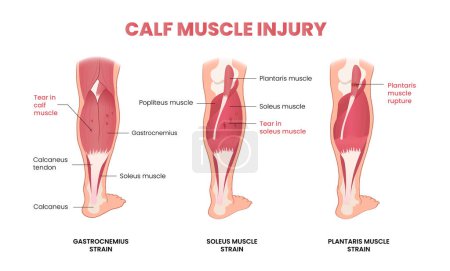 Illustration for Calf muscle injury infographic - Royalty Free Image