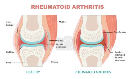 Vergleich zwischen gesundem Gelenk und rheumatoider Arthritis Illustration