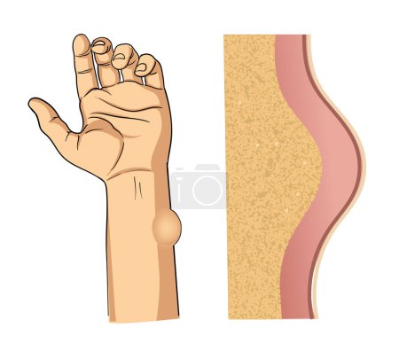 Illustration for Lipoma illustration in hand - Royalty Free Image