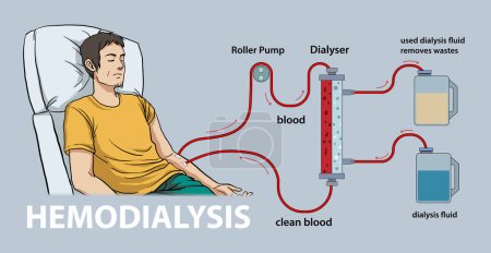 Illustration for Illustration of hemodialysis diagram - Royalty Free Image