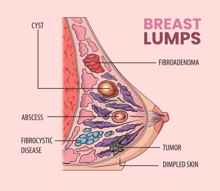 Illustration for Illustration of breast lumps types in women - Royalty Free Image