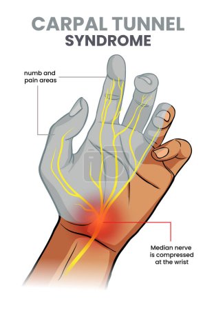 ilustración del síndrome del túnel carpiano con el área entumecida en la mano