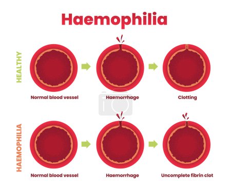 Ilustración de Ilustración de hemofilia, vaso sanguíneo sano vs hemofilia infografía - Imagen libre de derechos