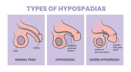 Ilustración de Tipos de ilustración de hipospadias - Imagen libre de derechos