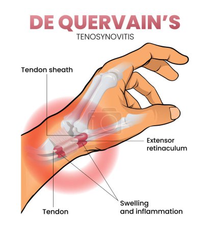 Illustration for Illustration of de quervain syndrome - Royalty Free Image