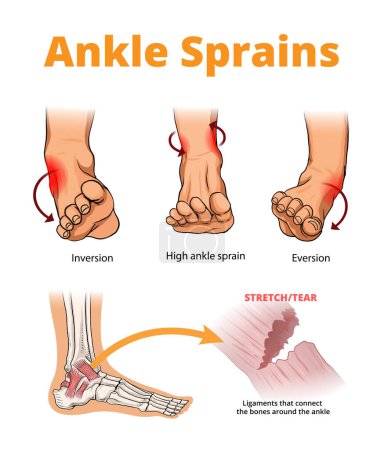 Illustration for Illustration of ankle sprains types - Royalty Free Image