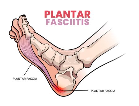 illustration of plantar fasciitis diagram