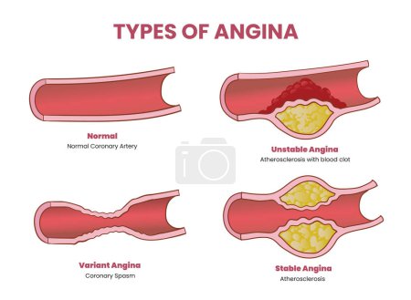 Ilustración de Tipos de ilustración angina - Imagen libre de derechos