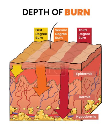 Illustration of burn degree level, depth of burn degree