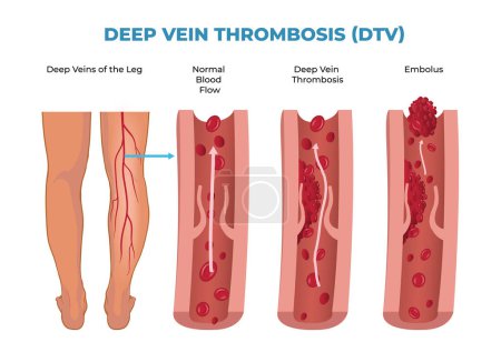 illustration of deep vein thrombosis diagram, DVT
