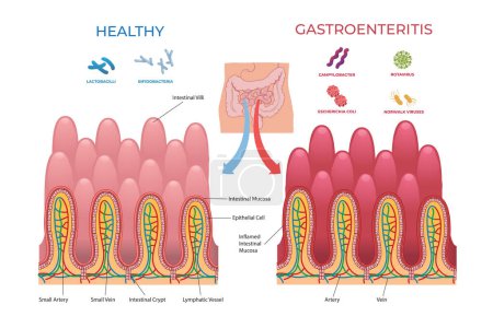 comparaison illustration entre intestin sain et gastro-entérite