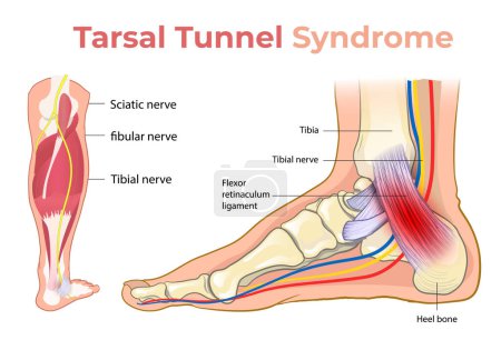 illustration of tarsal tunnel syndrome diagram