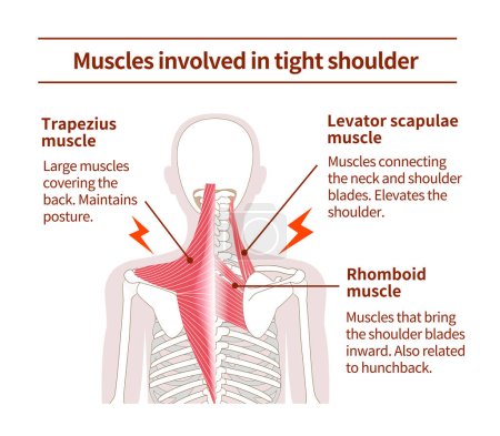 Ilustración de Conjuntos musculares en la espalda que causan hombro apretado - Imagen libre de derechos