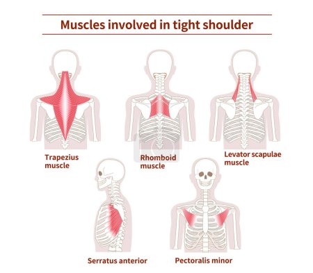 Illustration for Muscle sets in the back that cause tight shoulder - Royalty Free Image
