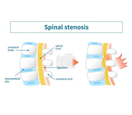 Ilustración de la estenosis del canal espinal lumbar