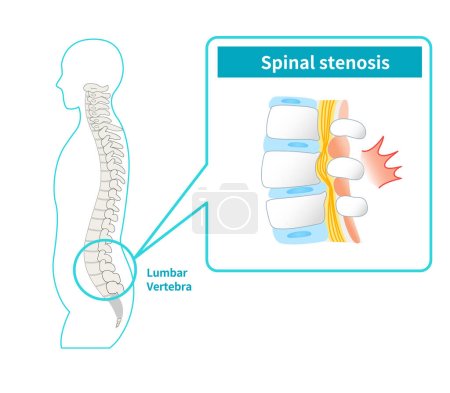 Ilustración de Ilustración de la estenosis del canal espinal lumbar - Imagen libre de derechos