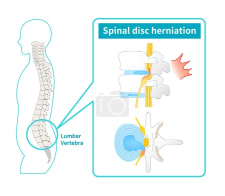 Ilustración de Ilustración de hernia discal lumbar - Imagen libre de derechos