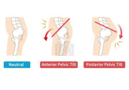 Illustration for Relationship between pelvic tilt and postur - Royalty Free Image
