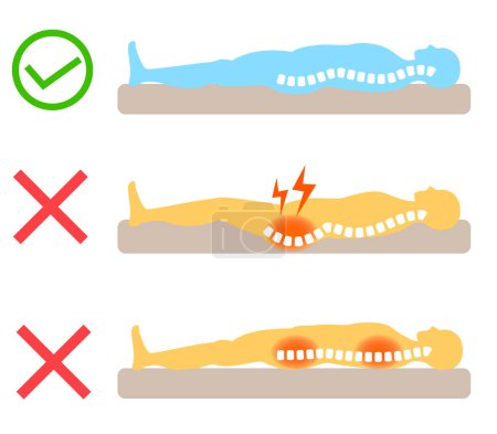 Ilustración de Causas del dolor de espalda: Relación entre la columna vertebral y los colchones y las camas - Imagen libre de derechos