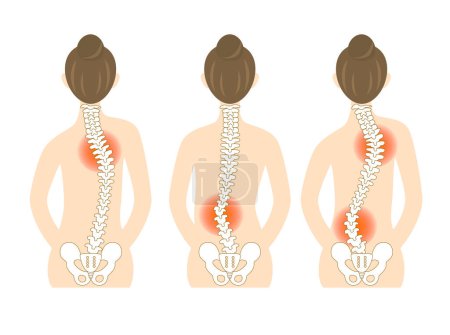 Illustration of the back of a woman with scoliosis and a bent spine
