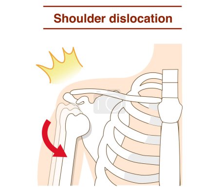 Illustration for Mechanism of shoulder joint dislocation - Royalty Free Image