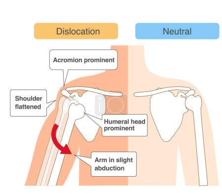 Illustration for Comparative chart of shoulder joint dislocation mechanism - Royalty Free Image