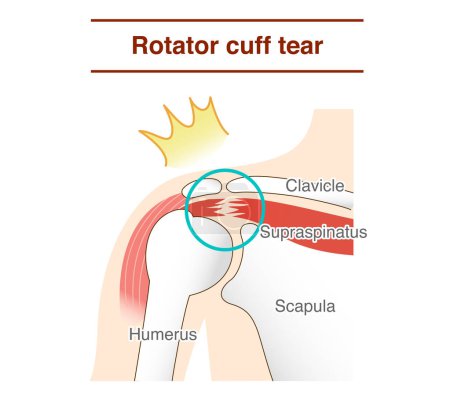 Illustration for How and why shoulder rotator cuff tears occur - Royalty Free Image