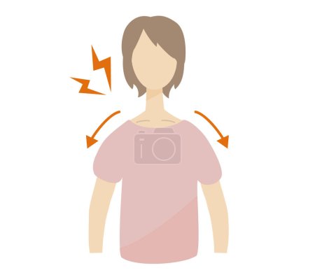 Ilustración de Una mujer con un hombro caído que sufre de síndrome de salida torácica - Imagen libre de derechos