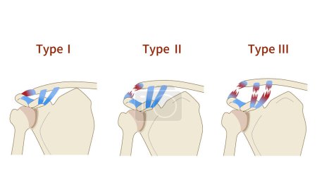 Ilustración de Tres etapas de dislocación de la articulación acromioclavicular - Imagen libre de derechos
