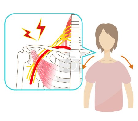 Téléchargez les illustrations : Une femme avec une épaule affaissée souffrant du syndrome de la sortie thoracique - en licence libre de droit