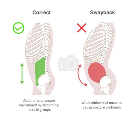 Illustration for Diagrammatic illustration of the relationship between abdominal muscle groups, abdominal pressure, and swayback posture, sideways - Royalty Free Image
