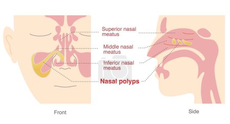 Téléchargez les illustrations : Illustration de polypes nasaux dans les sinus à partir des vues de face et de côté - en licence libre de droit