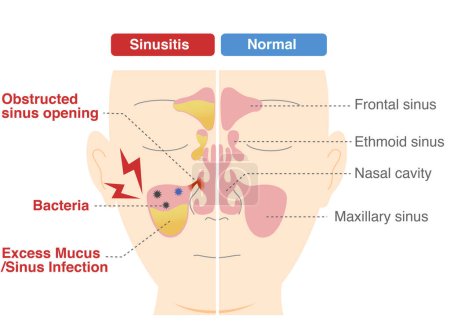 Comparative chart of how and why chronic sinusitis occurs