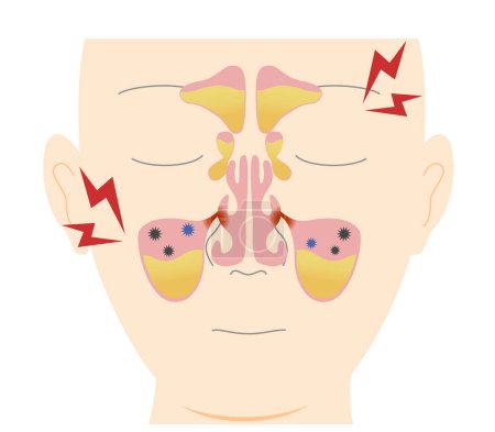 Cómo y por qué ocurre la sinusitis crónica