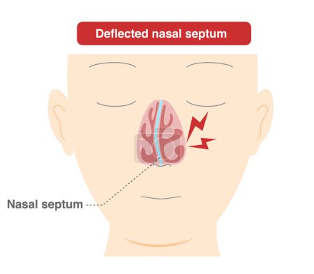 Illustration for Illustration of nasal diaphragm curvature caused by deformation of the nasal diaphragm - Royalty Free Image