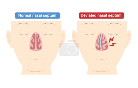 Ilustración de Ilustración de la curvatura del diafragma nasal causada por la deformación del diafragma nasal - Imagen libre de derechos