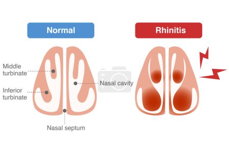 Dilatación de los vasos sanguíneos en el meato inferior durante la rinitis y congestión nasal
