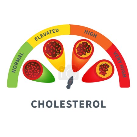 Illustration for Different stages of cholesterol plaque buildup in artery. Low to high fat count in blood vessel medical diagram. Meter gauge of ldl and hdl lipoprotein. Atherosclerosis risk indicator illustration. - Royalty Free Image