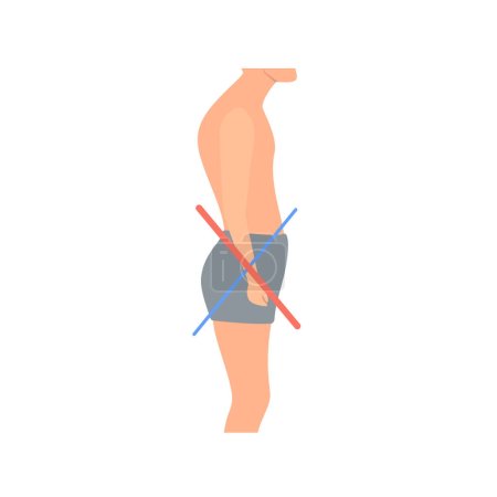 Ilustración de Diagrama médico del síndrome cruzado inferior. Hombre torcido con desequilibrio muscular. Terapia muscular débil y hiperactiva de la pelvis. Curvatura incorrecta de la columna causada por mala postura. Ilustración vectorial. - Imagen libre de derechos