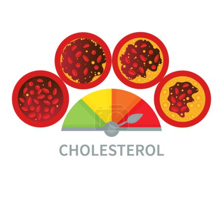 Ilustración de Nivel de acumulación de placa de colesterol en el diagrama médico de los vasos sanguíneos. Medidor de la lipoproteína ldl y hdl. Indicador de prueba alto y bajo en grasa. Riesgo de aterosclerosis. Concepto de salud. Ilustración vectorial - Imagen libre de derechos