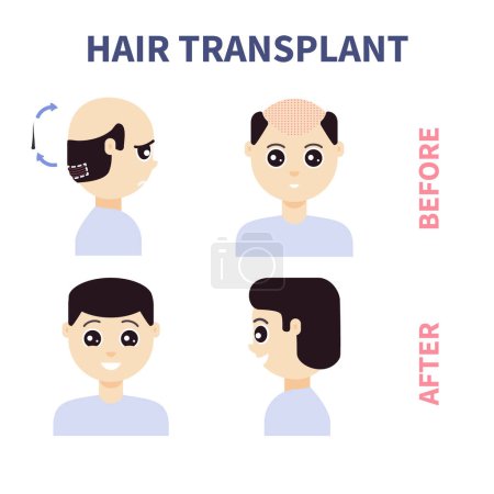 Illustration for FUE hair transplant treatment of alopecia. Front and side view of a man before and after surgery. Male hair loss pattern. Medical infographics. Cartoon vector illustration. - Royalty Free Image