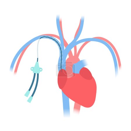 Tunneled central venous catheter placed in the subclavian vein. Patient with CVC long term access device for chemotherapy infusions and blood sampling. Central line tube close up. Vector illustration. 