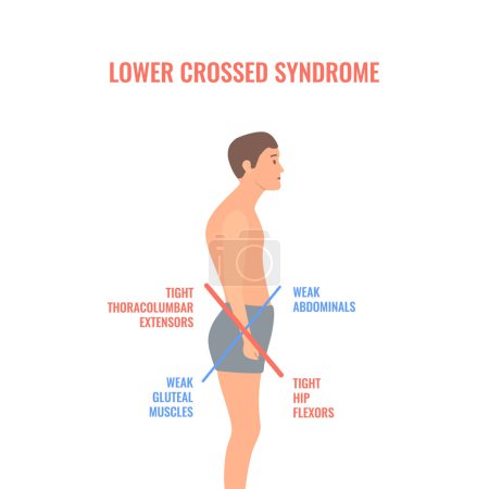 Lower crossed syndrome medical diagram. Crooked man with muscle strength imbalance. Weak and overactive pelvis muscles therapy. Incorrect spine curvature caused by bad posture. Vector illustration.