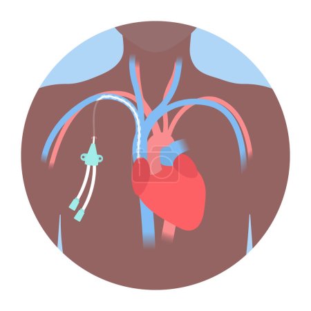 Illustration for Tunneled central venous catheter placed in the subclavian vein. Patient with CVC long term access device for chemotherapy infusions and blood sampling. Central line tube close up. Vector illustration. - Royalty Free Image